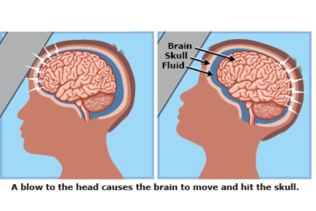 concussion-1