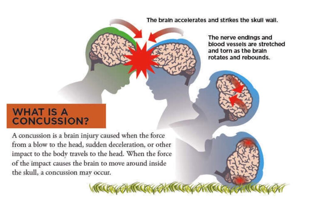 concussion-3